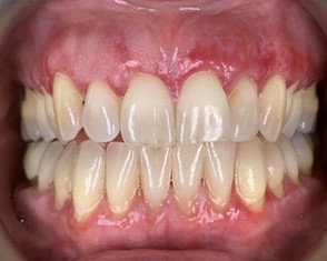 Erosive lichen planus of gingiva.