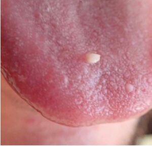 Mild to moderate dysplasia of dorsal tongue.