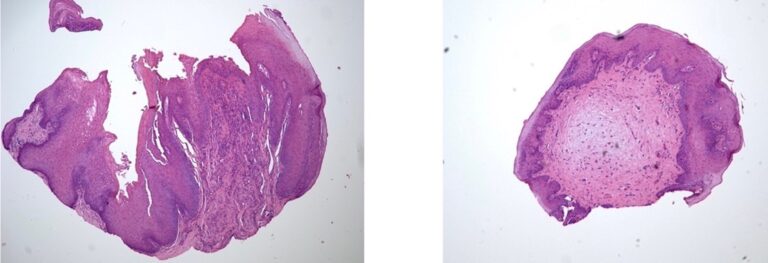 Histopathology, mild to moderate dysplasia (courtesy of Dr. Marco Magalhaes, Oral and Maxillofacial Pathology, University of Toronto).