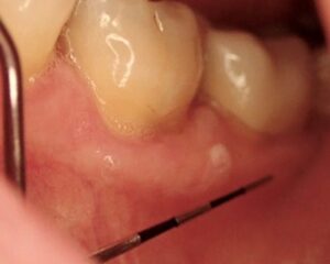 Mild dysplasia of gingiva