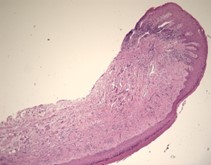 Histopathology, mild dysplasia (courtesy of Dr. Marco Magalhaes, Oral and Maxillofacial Pathology, University of Toronto.