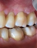 Second area, mild dysplasia of gingiva.