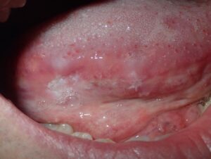 Superficially invasive squamous cell carcinoma of lateral tongue.