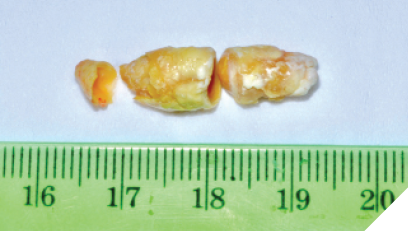 Surgically excised sialolith approximately 25 mm in length.