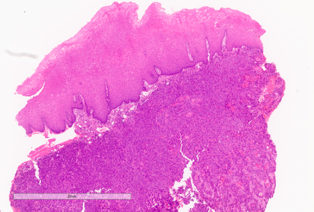 Histopathology, invasive, moderately differentiated, keratinizing squamous cell carcinoma of tongue, conventional type. Low power view showing squamous mucosa and underlying tumour.
