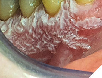 PVL affecting vestibular gingiva of lower right quadrant