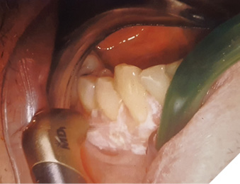 Ablation of gingival hyperkeratotic epithelium using YSGG laser.