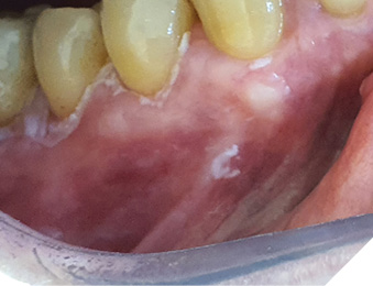 Recurrency of proliferative leukoplakia affecting marginal gingiva.