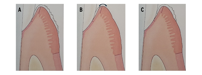 5A. hyperkeratosis before treatment localized on the surface oral gingival and sulcular epithelium, 5B. rest of hyperkeratosis covering sulcular epithelium after removal of oral part, 5C. residual hyperkeratosis as a source of recurrency.