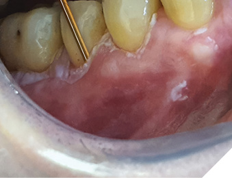 AAblation of intrasulcular hyperkeratosis using RFPT5.