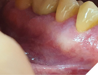 Area of treated PVL after 2 years of follow-up.