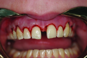 Retracted central incisor view, Intra-operative,following occusal re-contouring.