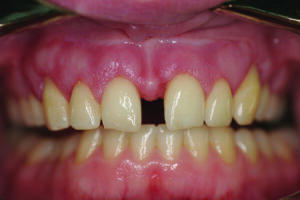 Retracted central incisor view, 2 months post-op, prior to venner preps.