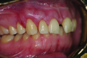 Retracted right lateral view.