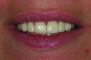 Smile, close-up, Post-delivery of venners.
