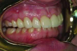 Retracted right lateral view.