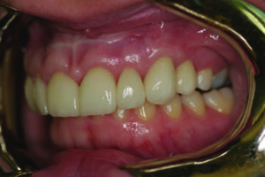 Retracted left lateral view.