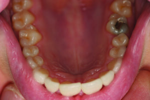 Maxillary occusal view.