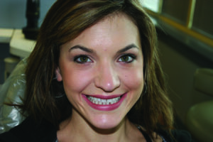 Full face smile, pre-treatment.