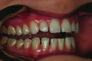 Retracted central incisor view.
