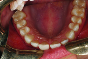 Maxillary occusal view.