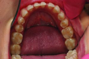 Mandibular occusal view.