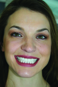 Full face smile, 2 weeks post-delivery of venners.