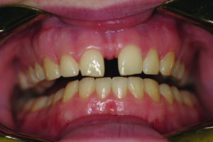 Retracted central incisor view.