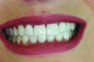 Smile, pre-treatment.