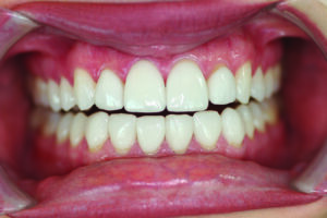 Retracted central incisor view.