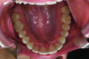 Maxillary occusal view.