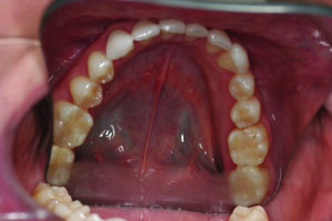 Mandibular occusal view.