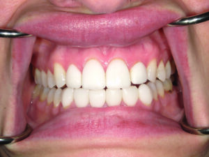 Retracted central incisor view.