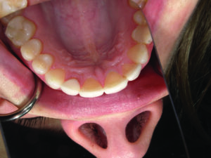 Maxillary occusal view.