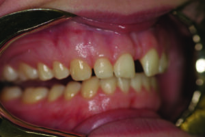 Retracted right lateral view.