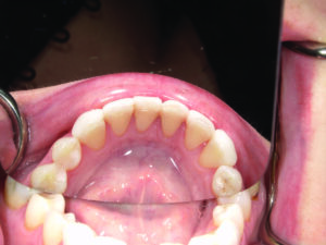 Mandibular occusal view.