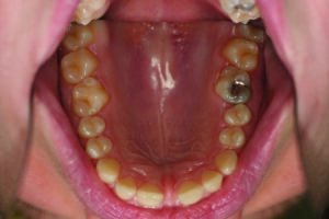 Maxillary occusal view.