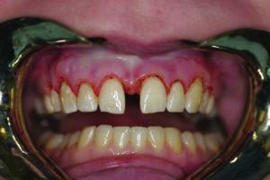 Retracted central incisor view, Intra-operative, soft tissue reduction