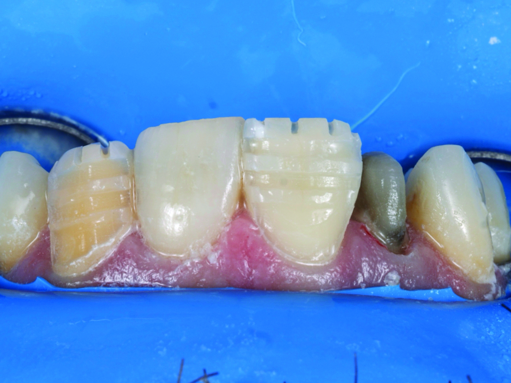 Tooth Malposition Animation The importance of creating an illusion for malpositioned teeth - Oral ...