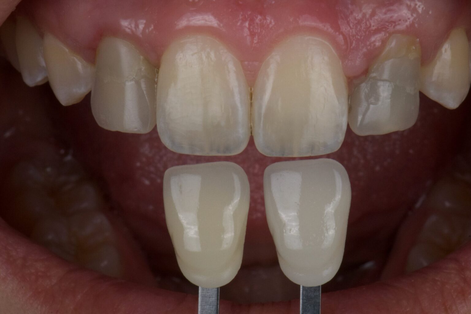 A new approach to anterior aesthetic prosthetics: Utilizing gray card ...