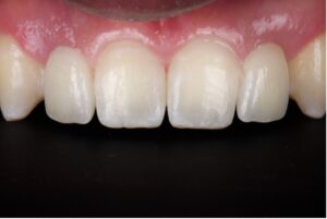 Final bonded Maryland bridges to replace congenitally missing teeth 12 and 22.