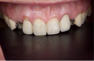 Initial situation after completion of orthodontic treatment showing the characteristics of the natural central incisors.