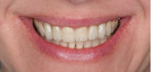 Final bonded Maryland bridges to replace congenitally missing teeth 12 and 22.