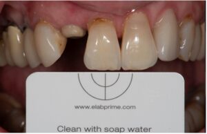 . Initial clinical photograph incorporating a gray card (eLab) for digital calibration.