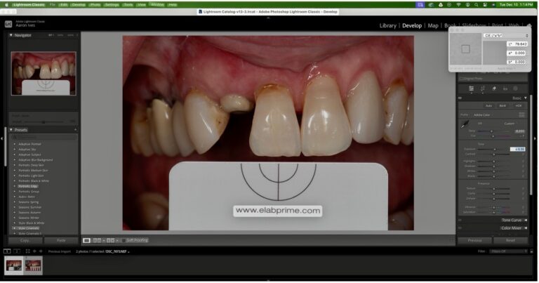 Color correction using Lightroom to standardize intraoral photography to the gray card Lab* values.