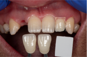 Digital shade verification after Miyo stain application and prior to intraoral try in.