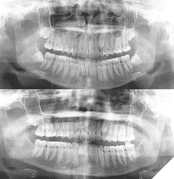 1A. Pre-surgery panorex showing the four impacted wisdom teeth. 1B.Post-surgery panorex showing two lower teeth having been extracted, displaced #28 between the molars. The procedure has aborted at this time of displacement.