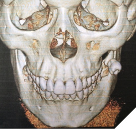 CT scan showing the displaced #18 in the buccal space.