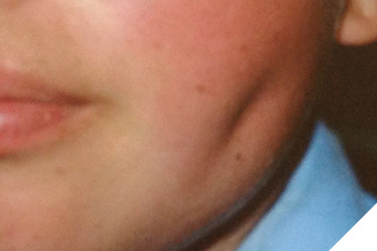 Patient with a noticeable ‘dimple’ in the left cheek following the removal of the tooth from an intra-oral approach.