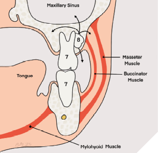 Cross section Illustration of buccal space and related anatomy. The arrows on the wisdom tooth indicate the possible directions it could be displaced—oral cavity, buccal space, maxillary sinus, lateral pharyngeal space and infratemporal fossa.